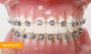 Что представляют собой самолигирующие брекеты H4? Их плюсы, минусы и особенности установки