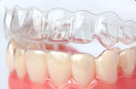 Брекеты или каппы – что выбрать для идеального выравнивания зубов?