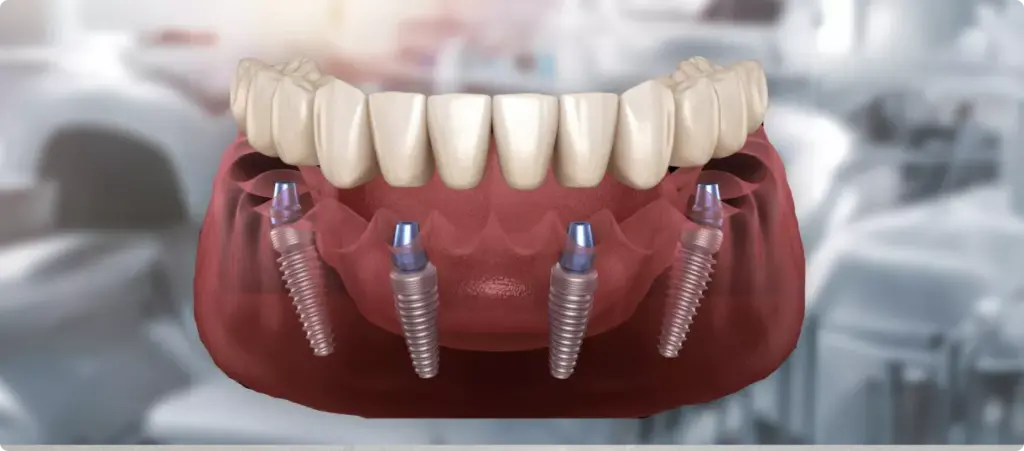Мифы и факты о зубных протезах All on 4