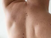 Вывих плечевого сустава от симптомов до реабилитации